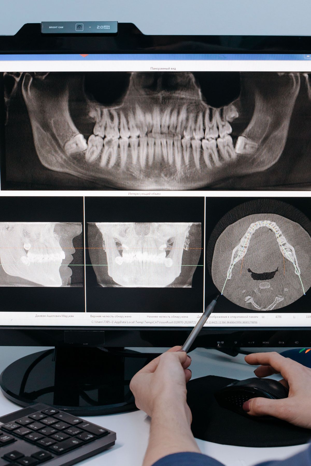 Radiografía panorámica en la pantalla, repasada con un lápiz
